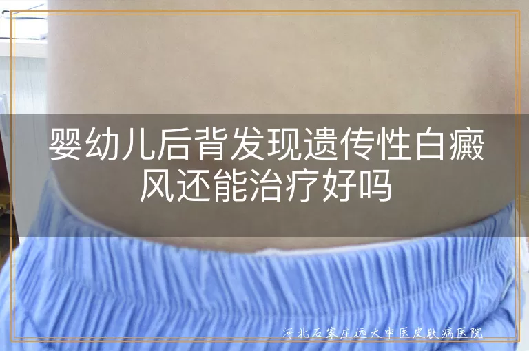 婴幼儿白癜风治疗,遗传性白斑控制,白斑恢复希望,白癜风治疗案例