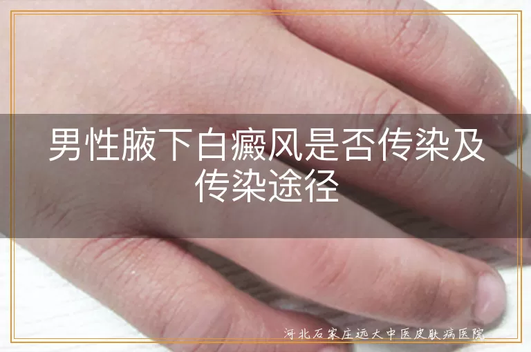 男性腋下白癜风是否传染,白癜风传染途径,白癜风诱发因素,白斑遗传与预防