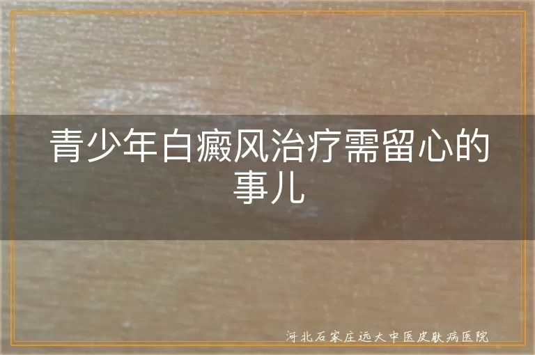 青少年白癜风治疗需留心的事儿