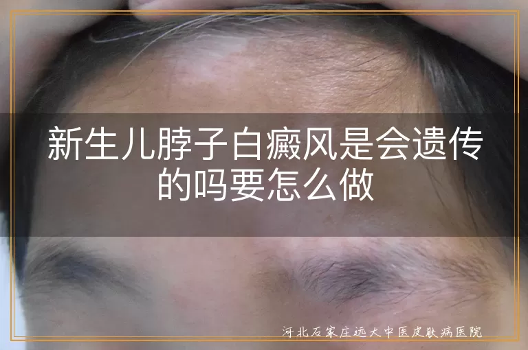 新生儿脖子白癜风遗传几率, 白癜风症状识别, 新生儿白斑治疗方法, 白癜风预防策略