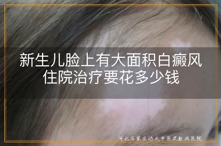 新生儿白癜风治疗费用,新生儿白斑治疗成本,大面积白癜风住院花费,新生儿白斑住院费用