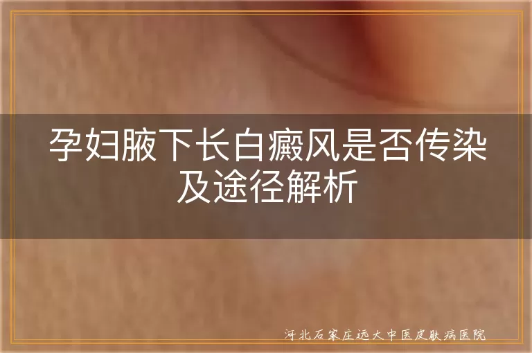 孕妇白癜风传染途径,白癜风是否传染,孕妇腋下白斑原因,白癜风对孕妇影响