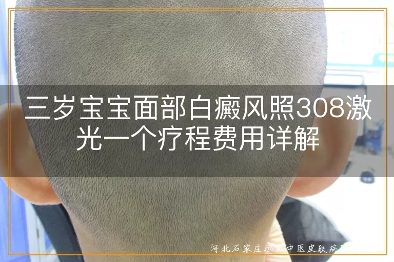 宝宝面部白癜风治疗费用, 三岁幼儿白斑激光费用, 儿童白癜风308激光疗程费, 幼儿白斑治疗费用