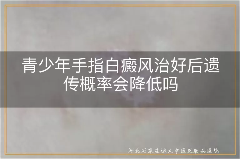 青少年白癜风遗传概率,白癜风治疗后遗传风险,手指白癜风遗传降低,白斑治愈后遗传影响