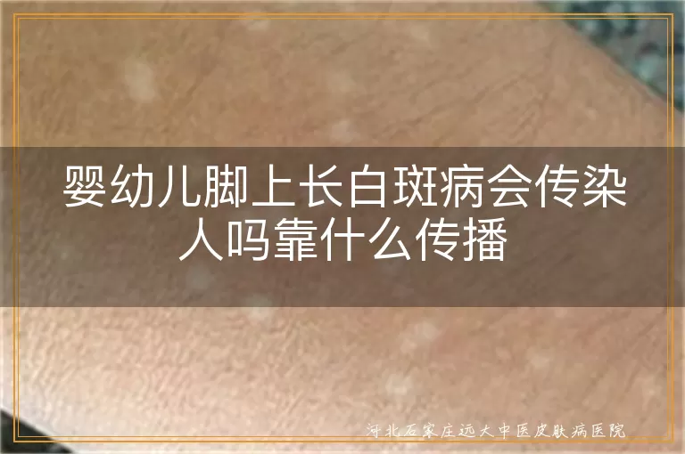 婴幼儿白癜风传染问题,白斑病传播途径,白斑病会不会传染,白癜风儿童护理