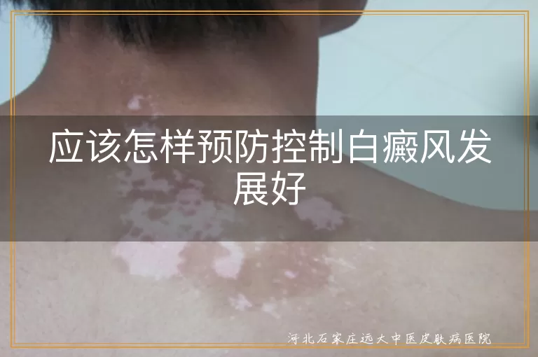 白癜风预防方法,白癜风控制措施,白斑日常护理,白斑治疗建议