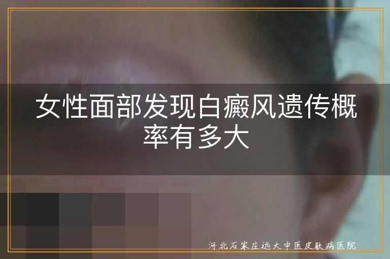 女性面部白癜风遗传概率,白斑遗传风险,白癜风遗传倾向,面部白斑遗传