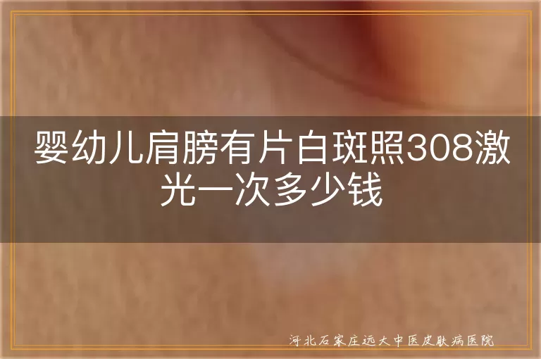 婴幼儿白癜风照308激光费用, 婴幼儿白斑308激光治疗价格, 白癜风儿童照308激光多少钱, 婴幼儿白斑激光治疗费用