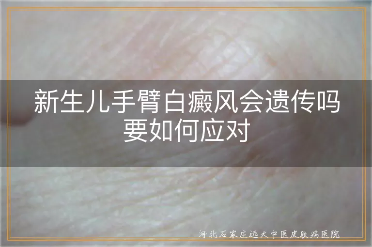新生儿白癜风遗传风险,白癜风遗传预防方法,白癜风患儿护理建议,白斑早期治疗重要性