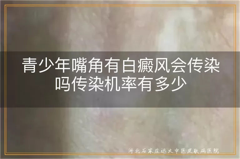 青少年白癜风传染问题,嘴角白斑传染机率,白癜风遗传与传染,白斑病是否传染