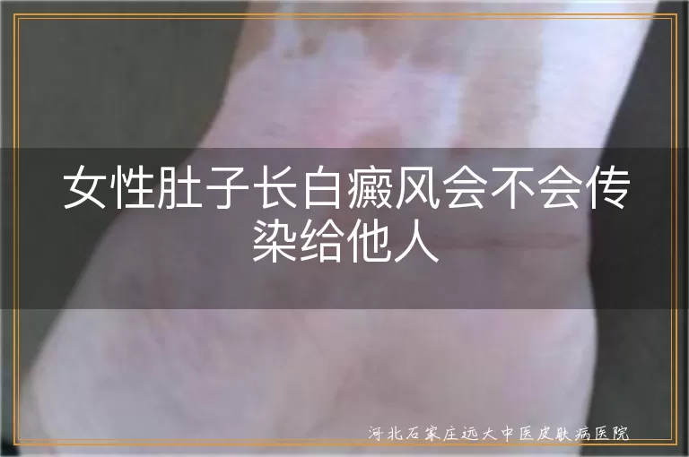 女性白癜风传染性,白斑病传染几率,白癜风是否传染,肚子白斑传染问题