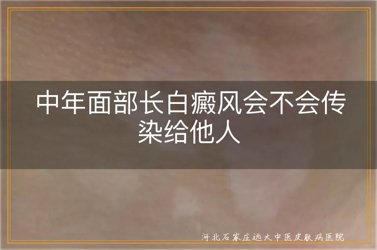 白癜风传染性问题,中年面部白斑治疗,白癜风遗传倾向,白癜风患者阳光照射