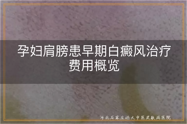孕妇肩膀白癜风治疗费用, 早期白癜风治疗费用概览, 白癜风治疗费用因素, 白斑治疗费用分析