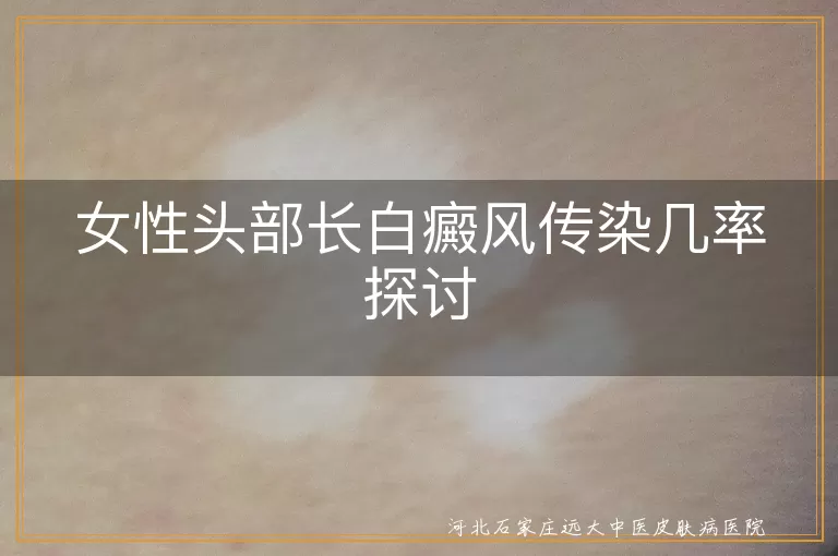 女性头部白癜风传染性,白癜风发病原因,白癜风科学治疗,白癜风生活预防