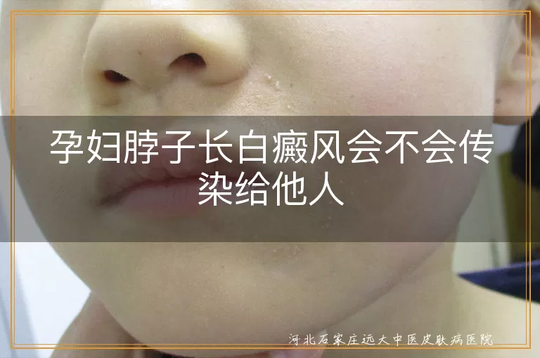 孕妇白癜风传染性,白癜风是否传染,孕妇白斑安全,白斑不会传染