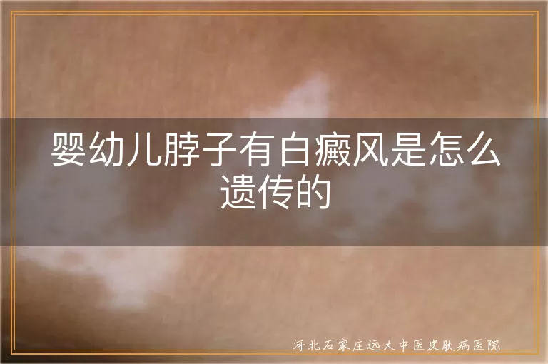 婴幼儿白癜风遗传方式, 婴幼儿白斑遗传概率, 白癜风多基因遗传, 婴幼儿白癜风发病因素