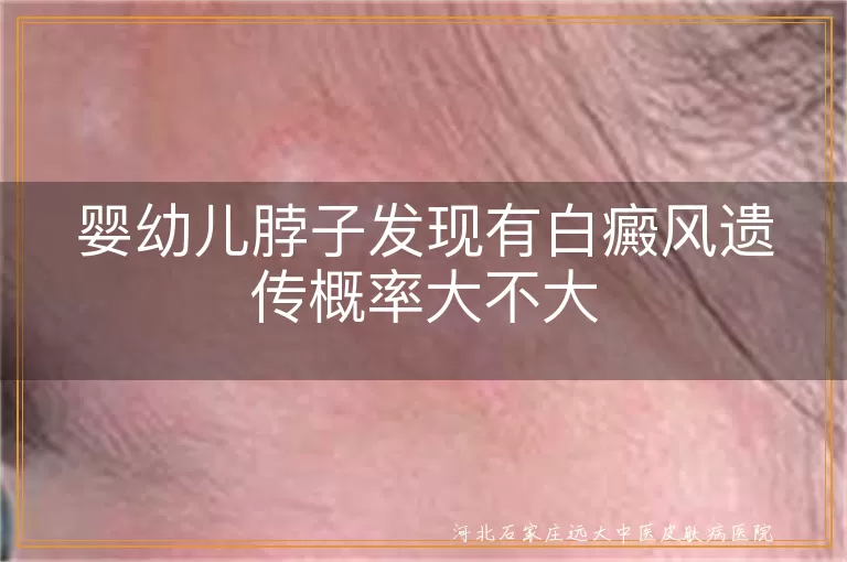 婴幼儿白癜风遗传概率,白斑遗传风险,白癜风家族病史,婴幼儿白斑治疗