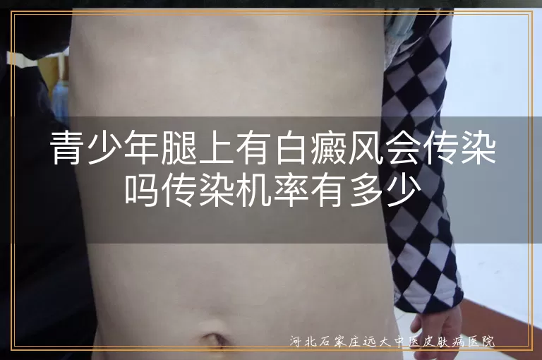 青少年白癜风传染机率,腿上白斑传染问题,白癜风非传染病,白斑治疗与理解