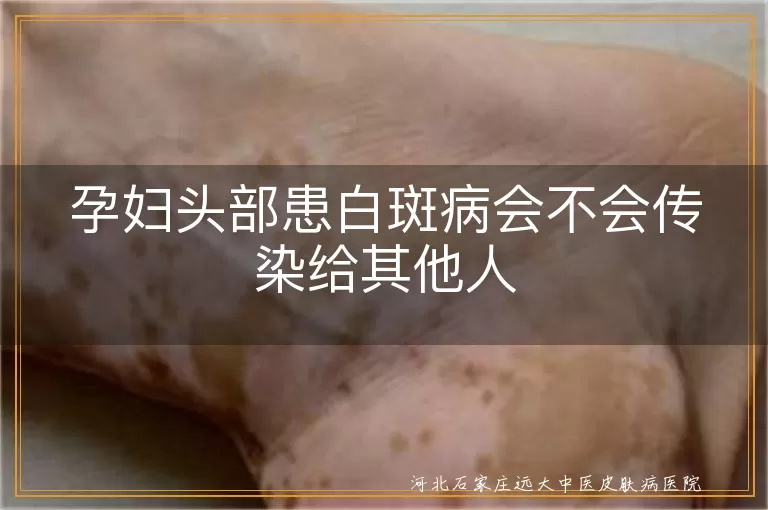 孕妇头部白癜风传染性,白斑病是否传染,孕妇白斑病对宝宝影响,白癜风治疗与心态