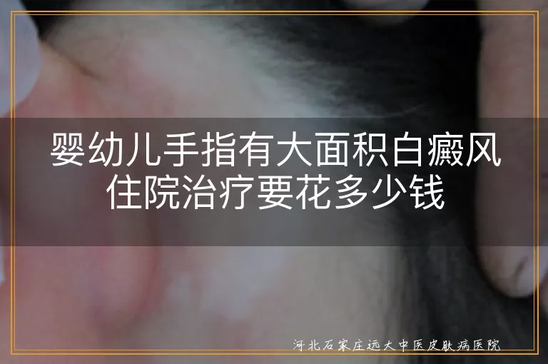 婴幼儿手指有大面积白癜风住院治疗要花多少钱