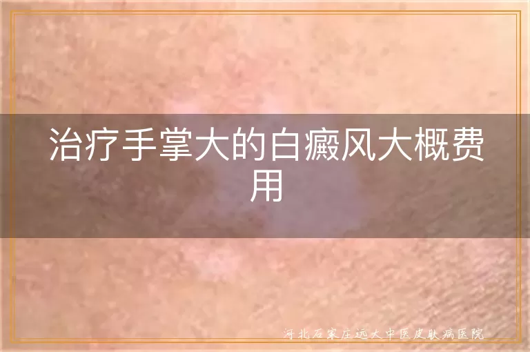 手掌大白癜风治疗费用, 白癜风治疗方式费用, 白斑治疗费用估算, 白癜风治疗注意事项