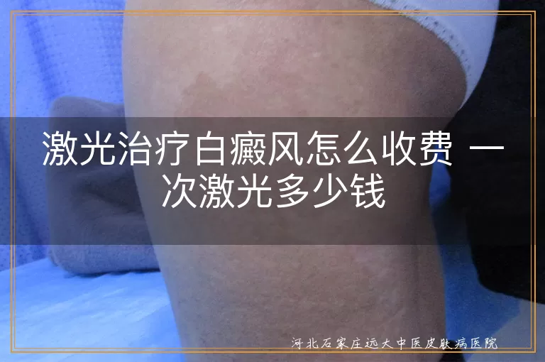 激光治疗白癜风费用,白斑激光治疗多少钱,白癜风激光治疗价格,白斑激光治疗收费