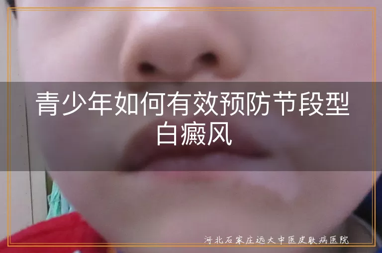 青少年如何有效预防节段型白癜风