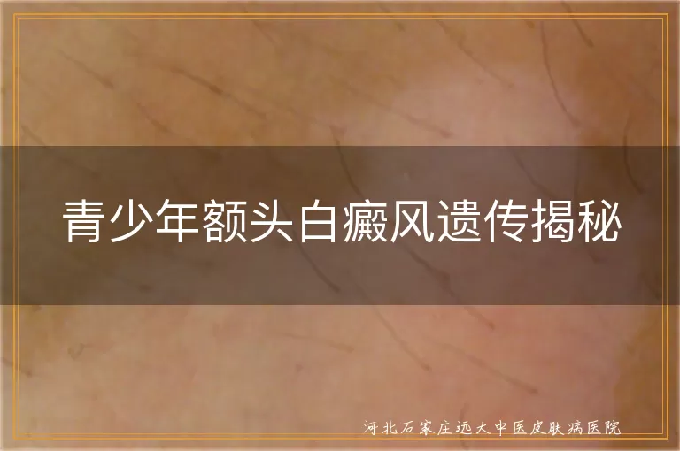 青少年额头白癜风遗传揭秘