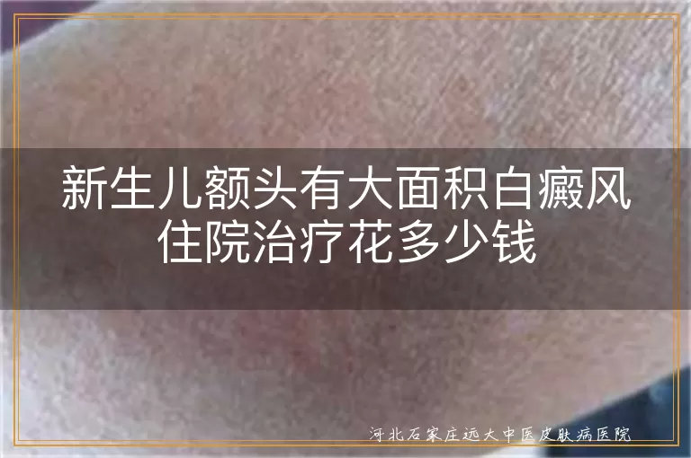 新生儿额头有大面积白癜风住院治疗花多少钱