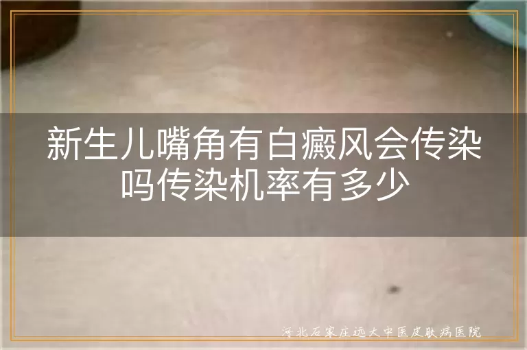 新生儿嘴角白癜风传染概率,白癜风白斑传染问题,白斑病是否会传染
