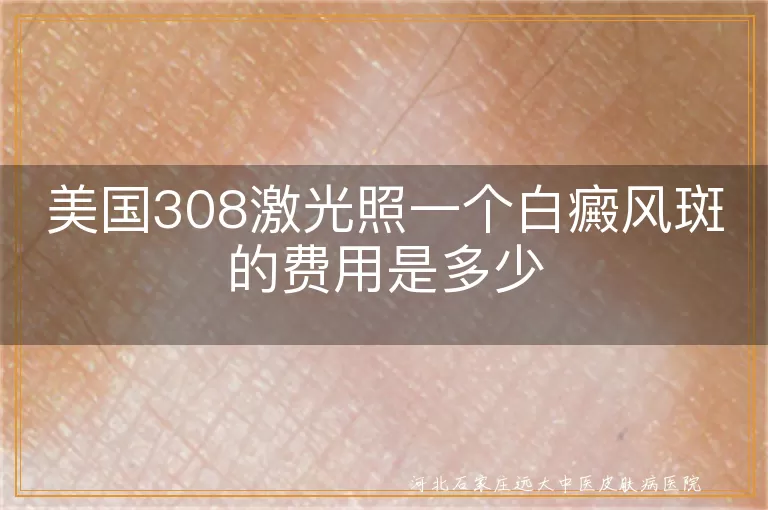 美国308激光治疗白癜风费用, 白癜风光斑治疗价格, 白斑308激光照射费用