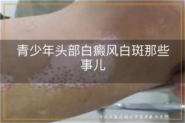 青少年白癜风遗传问题,白癜风白斑传染误解,白癜风白斑治疗方法