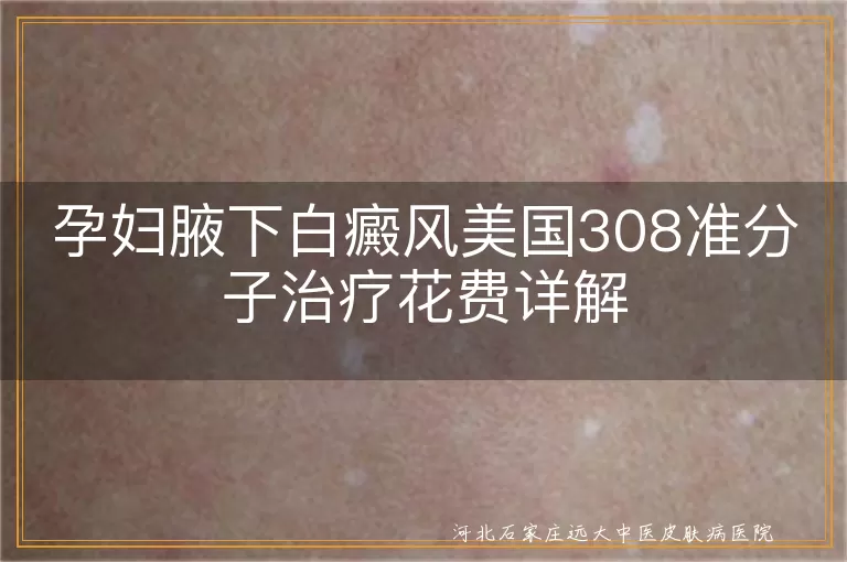 孕妇白癜风治疗费用,腋下白斑美国308疗法,孕期白斑安全治疗