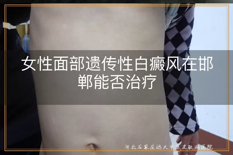 邯郸治疗女性面部白癜风,遗传性白斑专业治疗,女性白癜风治疗医院