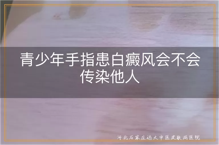 青少年白癜风传染性,白癜风是否会传染,白斑病不传染