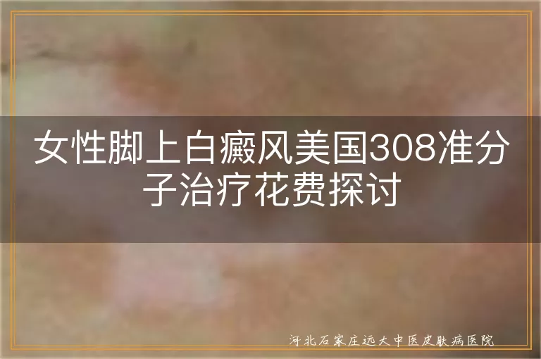 女性脚部白癜风治疗费用,308准分子治疗白癜风价格,白斑恢复美国308费用
