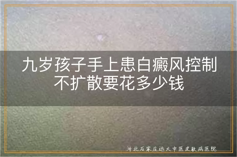 儿童白癜风治疗费用, 九岁孩子白斑控制费用, 白癜风治疗花费
