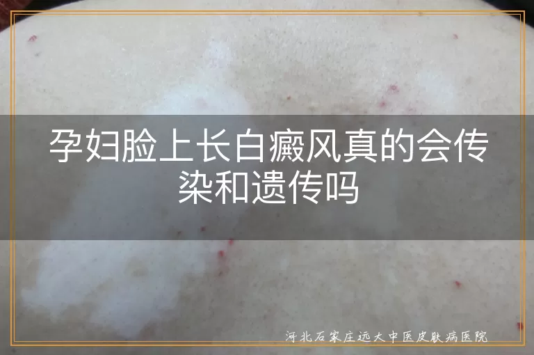 孕妇白癜风遗传概率,白斑病传染误区,孕期白斑预防