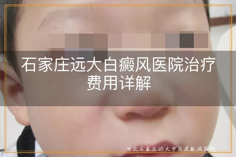 石家庄远大白癜风医院治疗花费,白癜风治疗费用明细,白斑治疗省钱方法