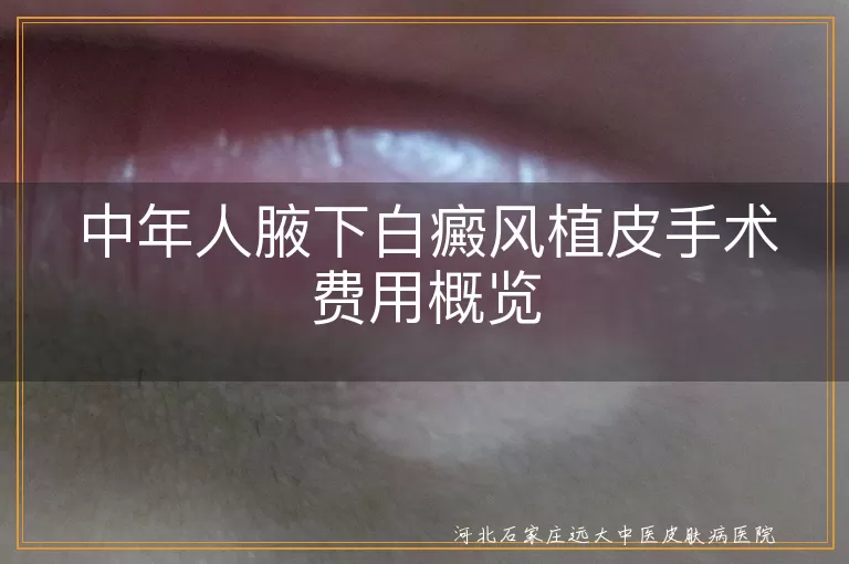 中年人白癜风植皮手术费用, 腋下白斑植皮治疗费用, 白癜风植皮手术价格估算