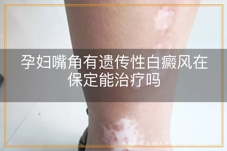 孕妇嘴角白癜风治疗保定, 保定白癜风医院孕妇治疗, 遗传性白斑孕妇保定治疗