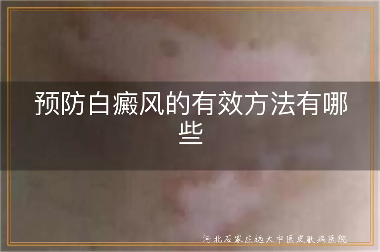 白癜风预防方法,白斑皮肤保护,减轻白癜风压力
