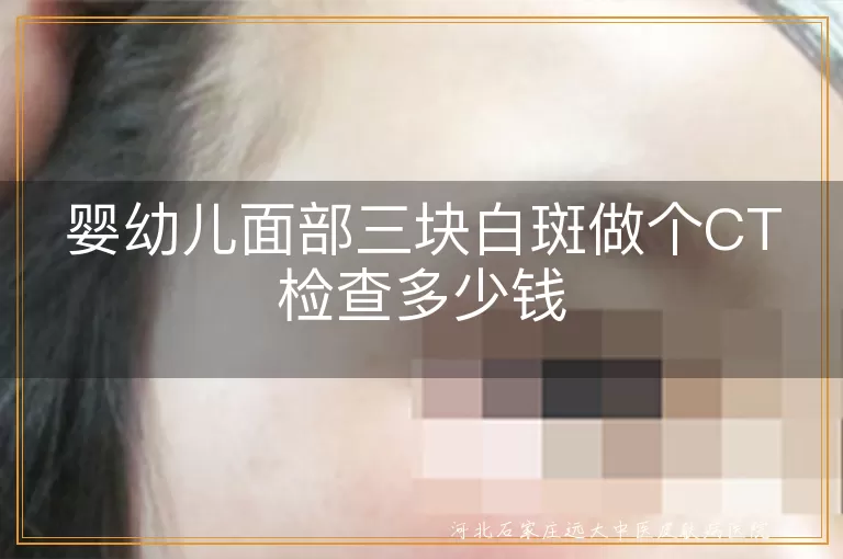 婴幼儿面部三块白斑做个CT检查多少钱