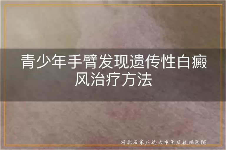 青少年遗传性白癜风治疗方法,手臂白斑治疗,白癜风综合疗法