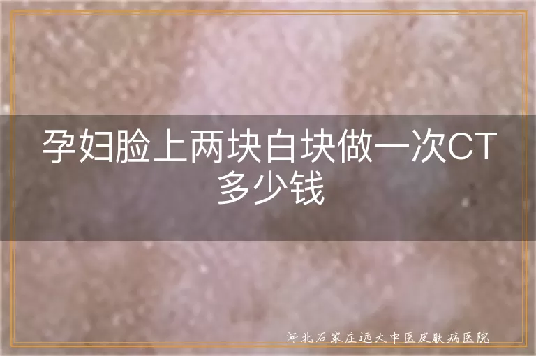 孕妇白癜风皮肤CT检查费用, 孕妇脸上白斑皮肤CT多少钱, 孕妇皮肤CT查白斑费用