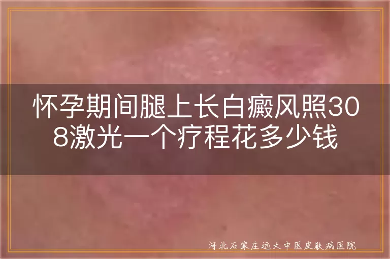 怀孕期间白癜风治疗费用, 白癜风308激光疗程价格, 白斑治疗一个疗程多少钱