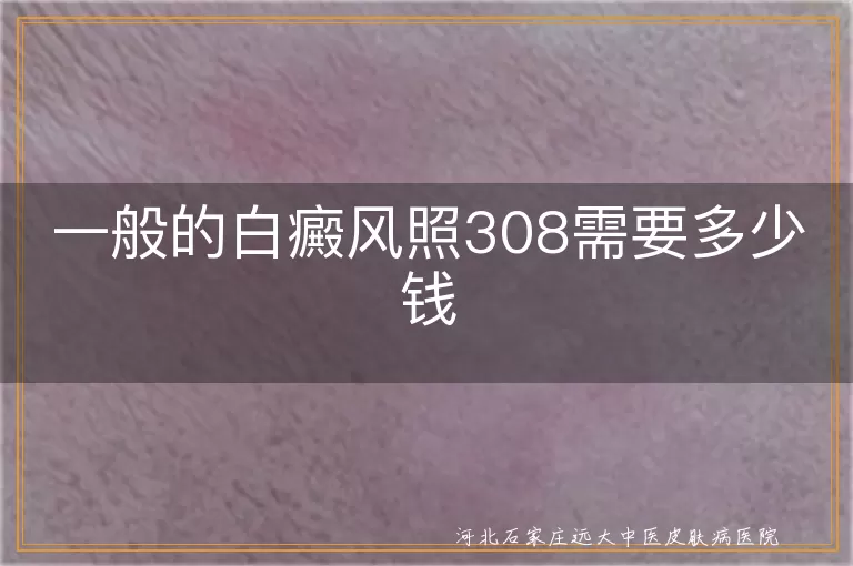 白癜风照308费用多少, 白斑治疗费用因素, 308激光治疗白斑价格