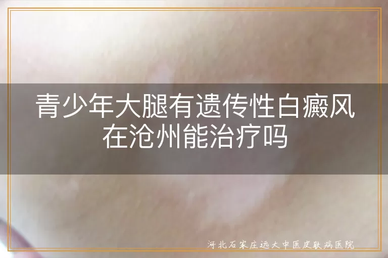 沧州治疗白癜风医院选择多,青少年大腿白癜风治疗方法全,白斑患者日常护理很重要