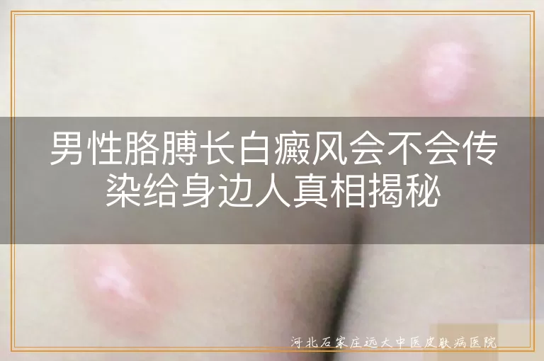 白癜风无传染性,白癜风成因复杂,白癜风科学治疗