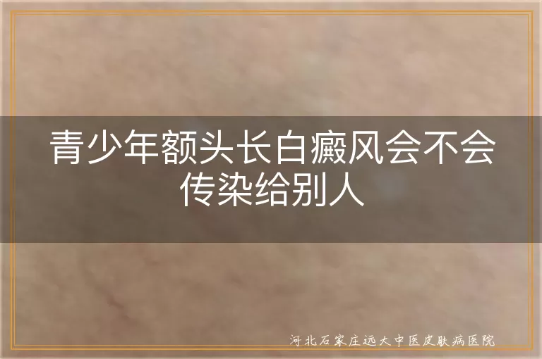 青少年白癜风传染性,白癜风是否传染,白斑病传染性
